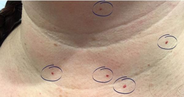 Benign Pigmented Lesion