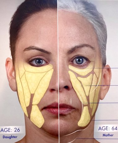 filler location by age