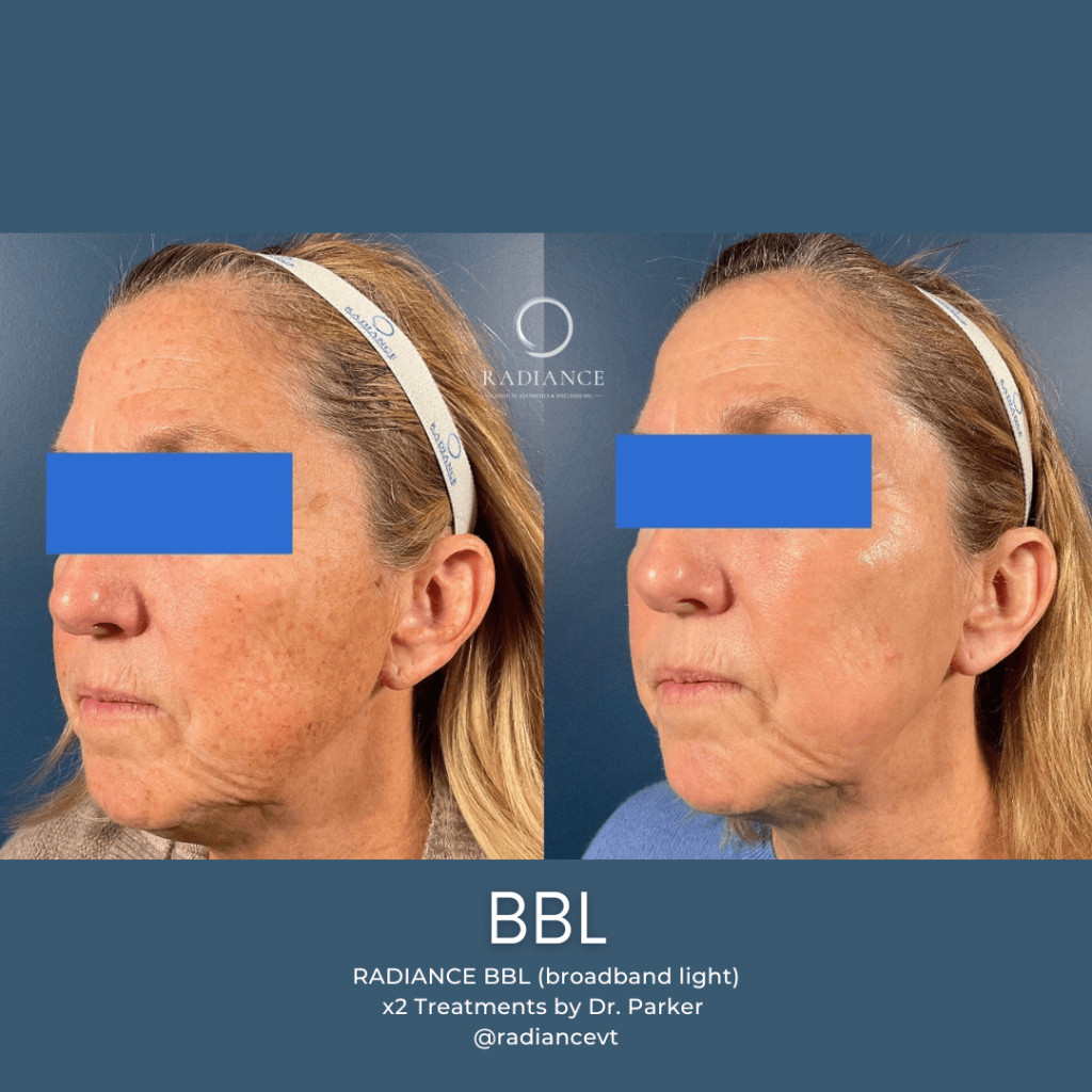 BBL for pigmentation before & after