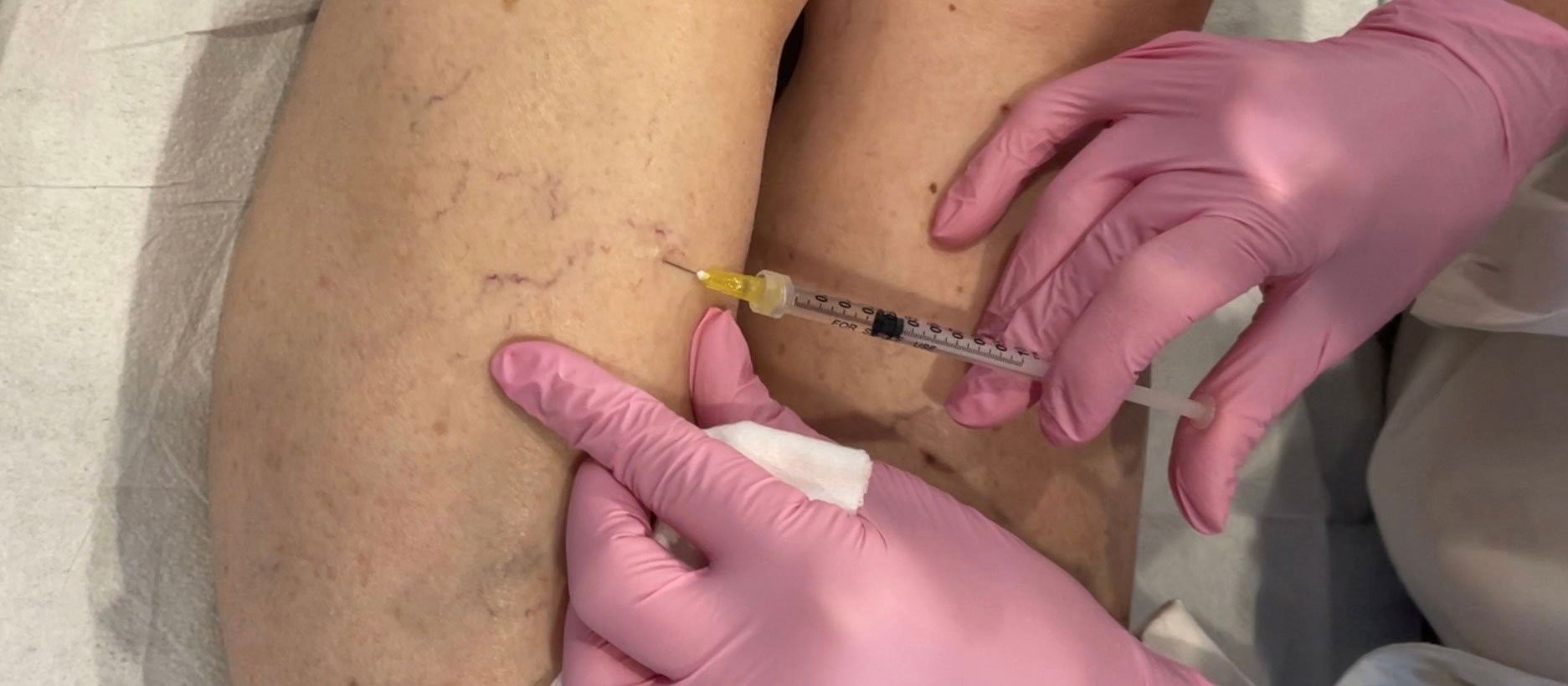 Sclerotherapy for Leg Veins in Williston, VT