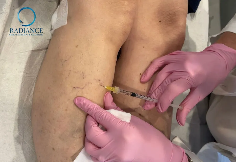 New treatments for Leg Veins in Williston, Vermont