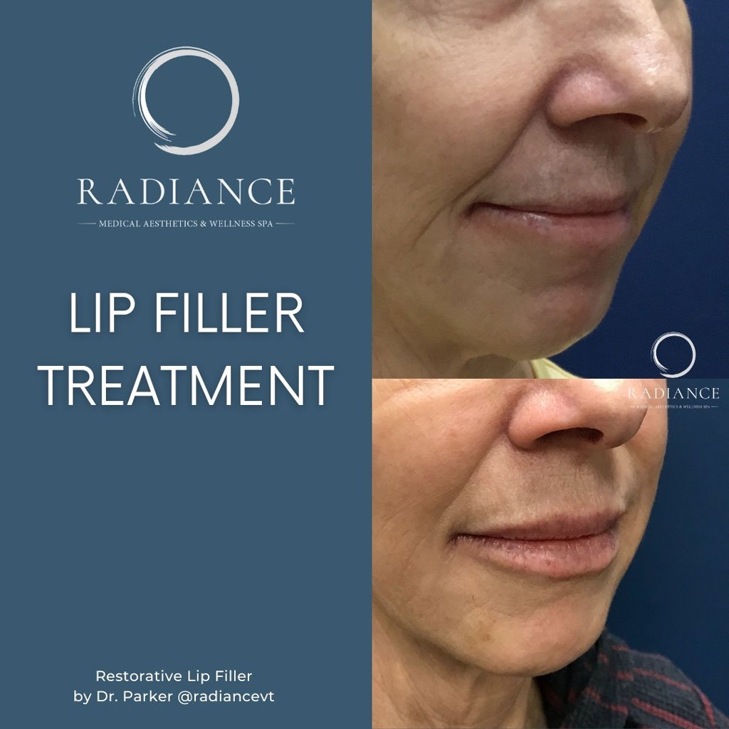 lip line treatment with dermal filler