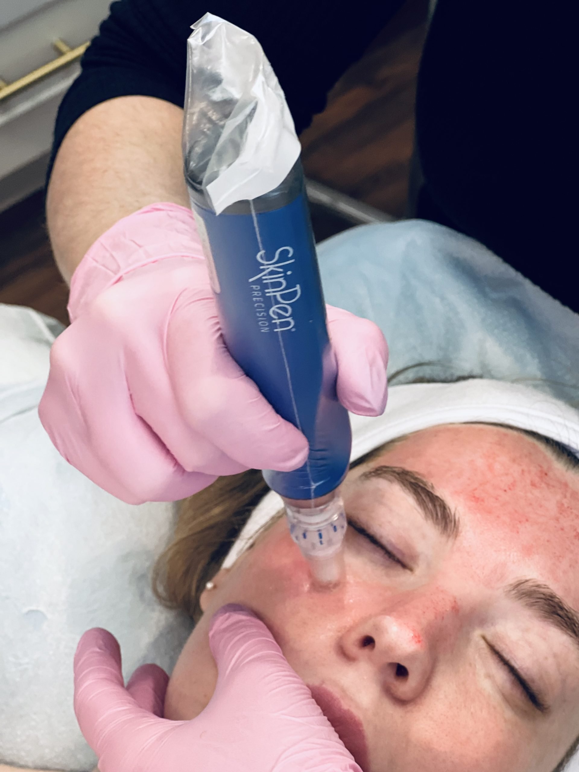 Microneedling Treatment