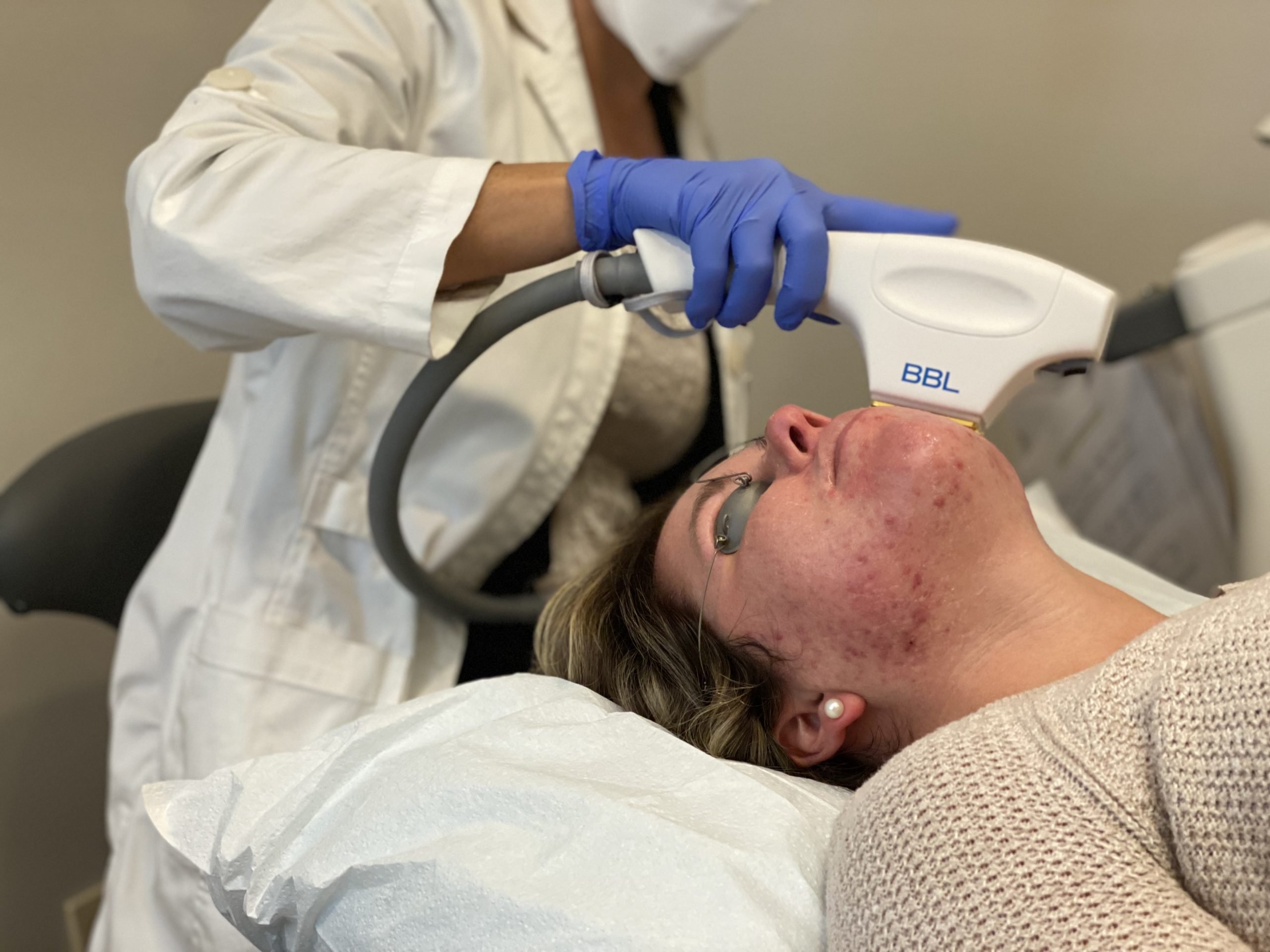 BBL for Acne Treatment in Williston, VT