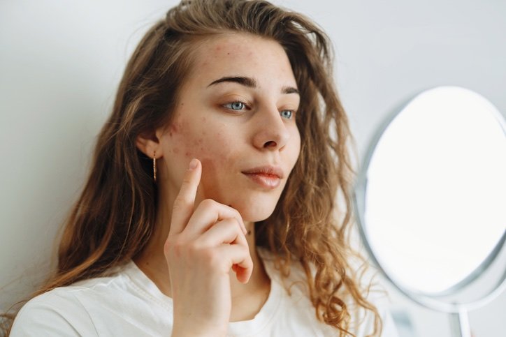 Adult acne treatment Williston, VT