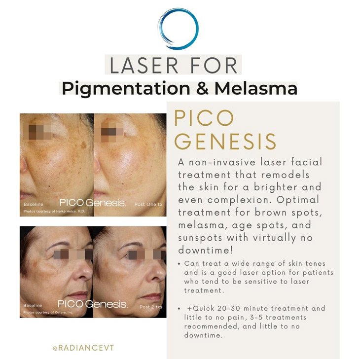 Laser for Pigmentation and Melasma