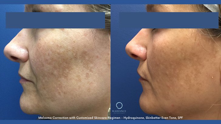 Why Is My Pigmentation Worse After Summer, Even with Sunscreen?